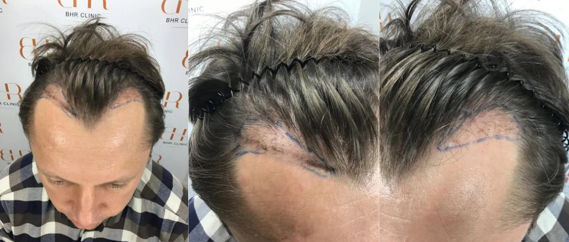 14 Monate nach der Haartransplantationsreparatur