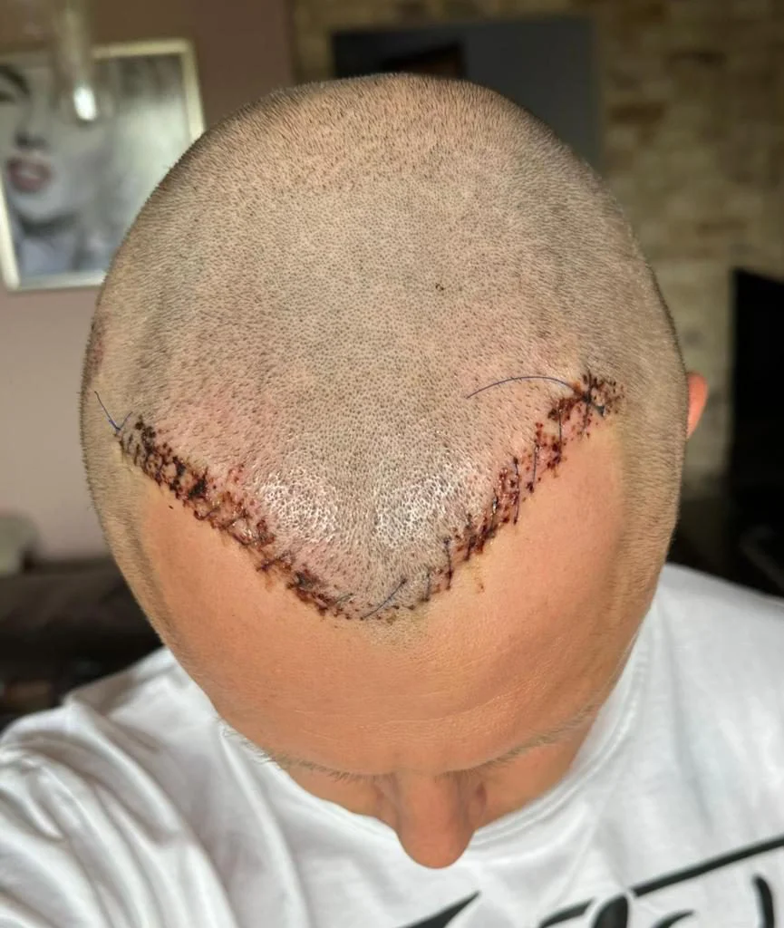 Nach der Haartransplantationsreparatur