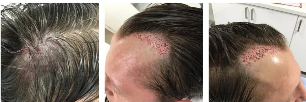 Letzte Entfernung Platzierung von Grafts