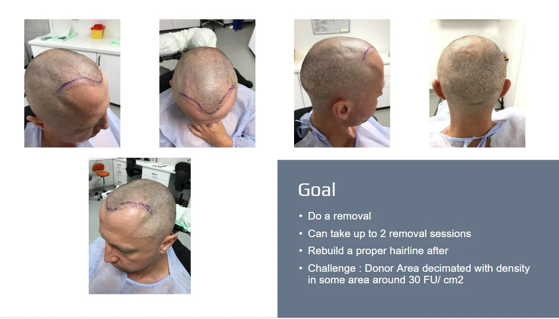 Haartransplantationsreparatur